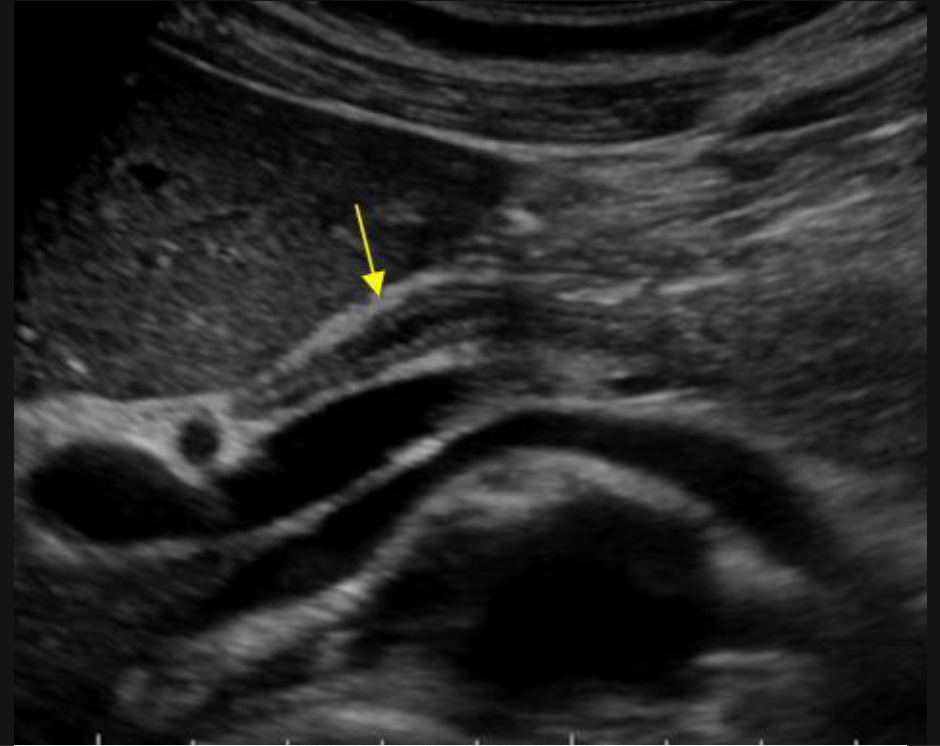 <p>B<span>iliary duct infection, often due to obstruction </span></p><p><span>Duct wall thickening, dirty echoes in bile ducts, dilated intrahepatic ducts, possible abscess </span></p>