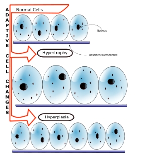 <p>Hyperplasia pathologic</p>