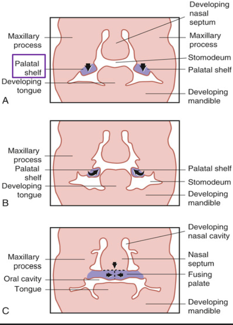 <p>Timing: Begins around week 6–7 of embryonic development.</p><p><strong>Origin: From the maxillary processes</strong> → form lateral palatine shelves (outgrowths on either side of the tongue).</p><p><strong>Process:</strong></p><ul><li><p>2 shelves form vertically alongside the tongue from the 2 lateral maxillary processes&nbsp;</p></li><li><p>As the tongue begins to move, shelves elevate (flip-up) to a horizontal position above it.</p></li><li><p>Shelves grow medially and fuse at the midline → forming the secondary palate.</p></li><li><p>Fusion also occurs anteriorly with the primary palate and superiorly with the nasal septum.</p></li></ul><p>Result:</p><ul><li><p>Separates oral and nasal cavities posteriorly.</p></li><li><p>Forms hard and soft palate (posterior 2/3rds of the final palate), uvula</p></li></ul><p></p>
