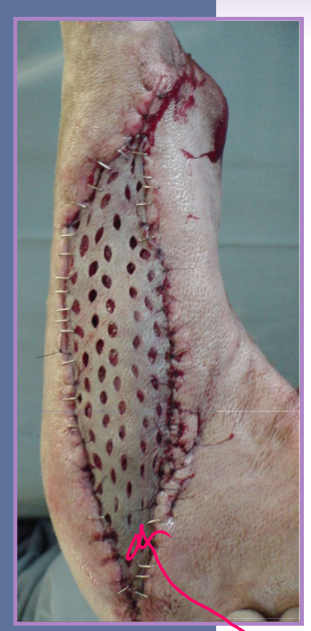 <ul><li><p>transfer of a segment of free dermis and epidermis to a distant recipient site </p></li><li><p>full thickness (recommended)* </p><ul><li><p>epidermis and dermis </p></li></ul></li><li><p>partial thickness </p><ul><li><p>epidermis and variable dermis - part </p></li><li><p>cannot do in cats (too thin) </p></li></ul></li><li><p>types </p><ul><li><p>sheet or mesh (often preferred) </p></li><li><p>punch, stamp, stripe </p><ul><li><p>mesh preferred b/c </p><ul><li><p>increased surface area </p></li><li><p>better conformity </p></li><li><p>fluid drainage </p></li></ul></li></ul></li></ul></li><li><p>factors <strong>critical </strong>to graft survival </p><ul><li><p>healthy vascular bed - no infection </p></li><li><p>lack of motion </p></li><li><p>contact between the bed and graft </p></li><li><p>lack of infection </p></li></ul></li></ul><p></p>