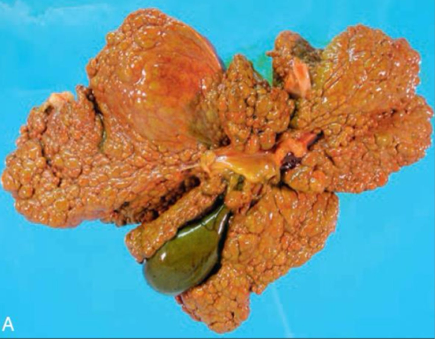 <p>Bridging fibrosis, formation of regenerative nodules</p>