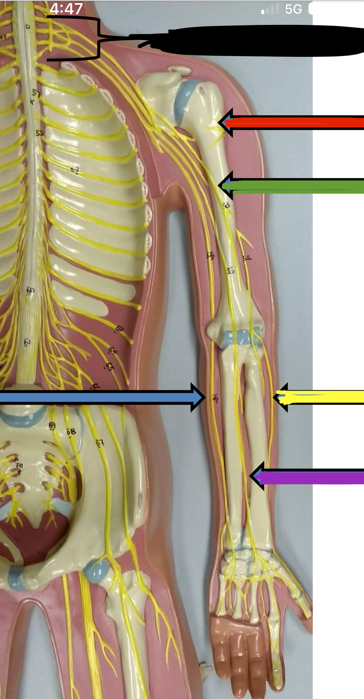 <p>Red points to what nerve of the brachial plexus</p>