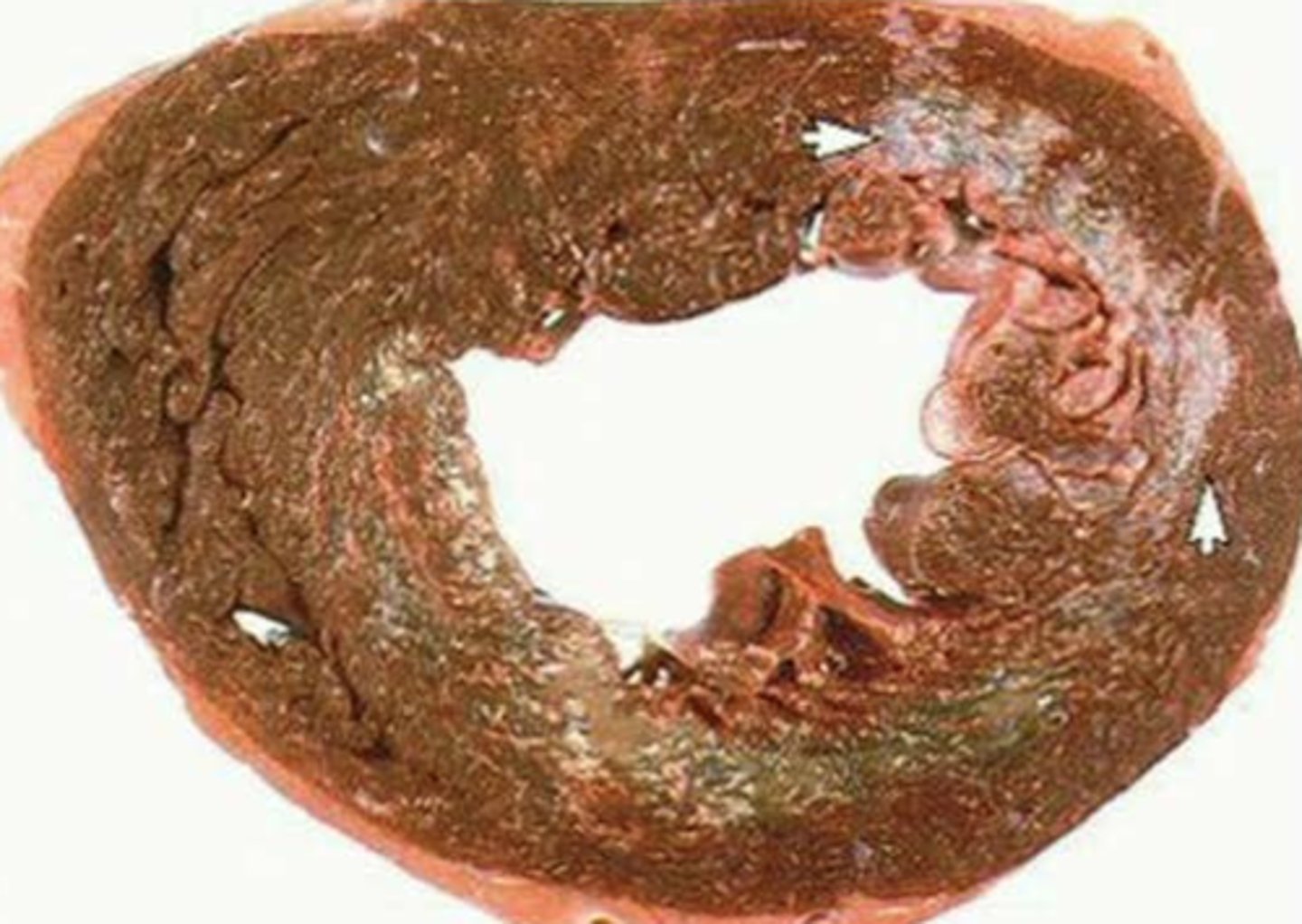 <p>Endocardium→inner lining, lined by endothelial cells</p><p>Myocardium→middle layer, 95% cardiomyocytes by mass</p><p>Epicardium→outer layer</p>