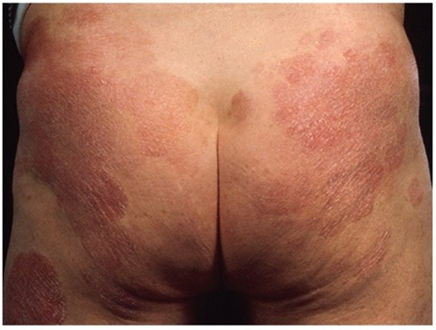 <p>Cutaneous T-Cell Lymphoma</p><p>Commonly affects the Axilla + Buttocks</p><p>Sx</p><p>-Erythematous wrinkled scaly skin patches</p><p>Complications</p><p>-Thickening of skin patches</p><p>-Progression of skin patches into tumors</p>