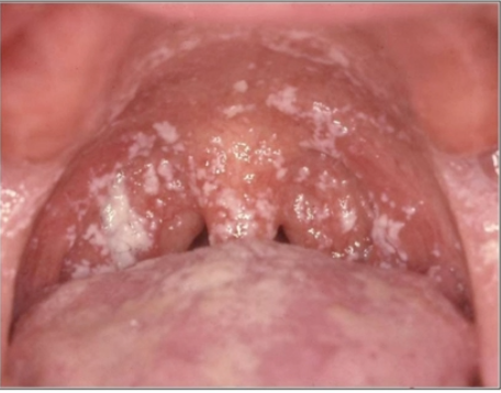 <p>patient complains of <strong>metallic taste</strong> and <strong>burning sensation</strong>, diagnosis? </p>