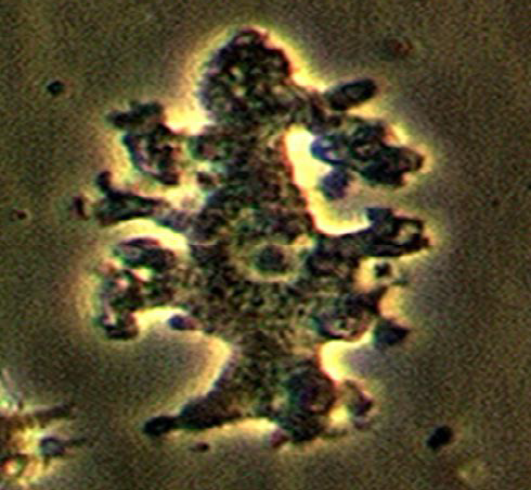 <p><strong>Identify the parasitic stage.</strong></p><ul><li><p><em>Balamuthia mandrillaris</em> trophozoite</p></li></ul><p><strong>Mention two morphological characteristics of this stage.</strong></p><ul><li><p>Pleomorphic, large (12–60 µm)</p></li><li><p>Actively motile by broad or finger-like pseudopodia</p></li></ul><p><strong>Mention the possible human samples used for diagnosis, and the culture medium used.</strong></p><ul><li><p><strong>Samples:</strong> CSF, brain tissue, and skin biopsy</p></li><li><p><strong>Culture medium:</strong> Non-nutrient agar (1.5%) enriched with <em>Escherichia coli</em></p></li></ul><p></p>