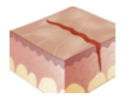 <p>Secondary Skin Lesion</p><ul><li><p><strong>Linear crack</strong> on skin</p></li><li><p>E.g. tinea pedis/Athlete’s foot, Cheilosis</p></li></ul><p></p>