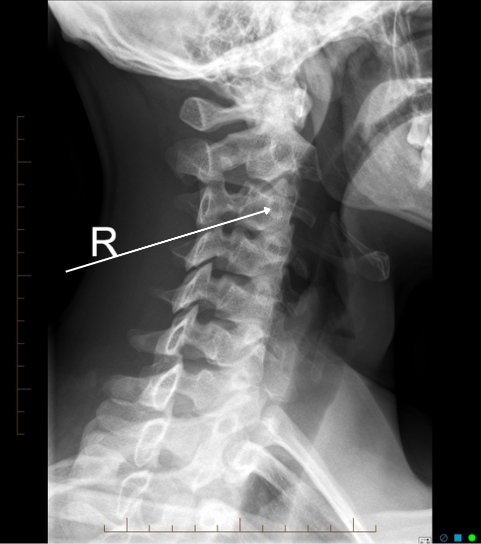 <p>right AP oblique</p>
