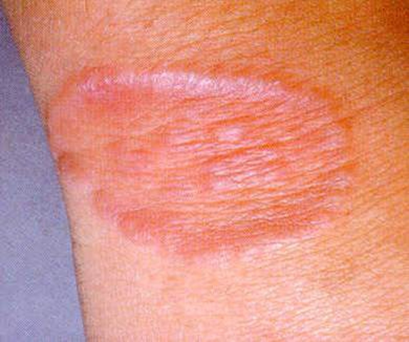 <p>a hunk of tissue that has been chronically inflamed and is now essentially just scar tissue</p>