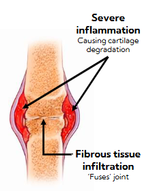 <p>autoimmune disease</p><p>inflammation of synovial cavity and cartilage decreases your mobility over time</p><p>eventually cartilage degrades and leads to exposed bone ends</p><p>nutrient change issues</p>
