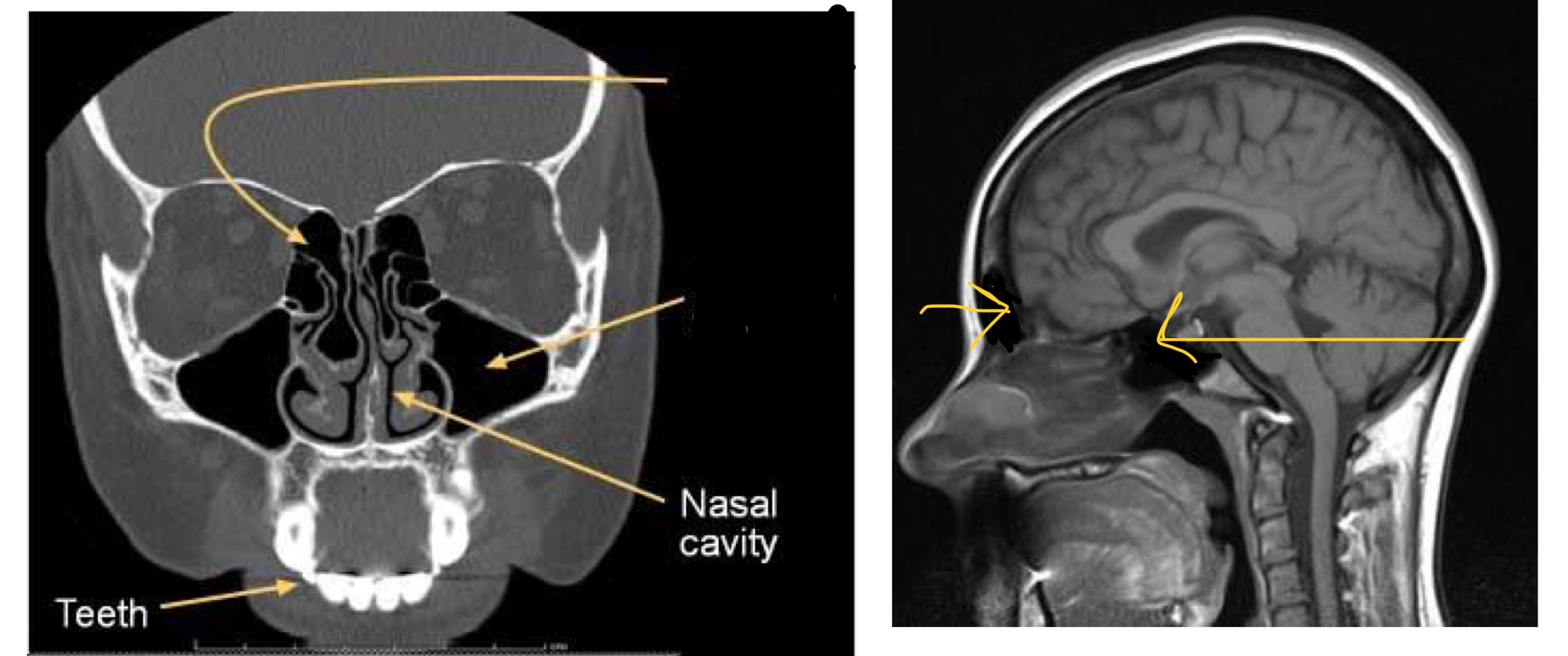 <p>Identify these sinuses</p>