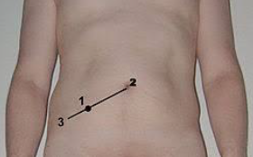 <p>RLQ - Appendicitis</p>