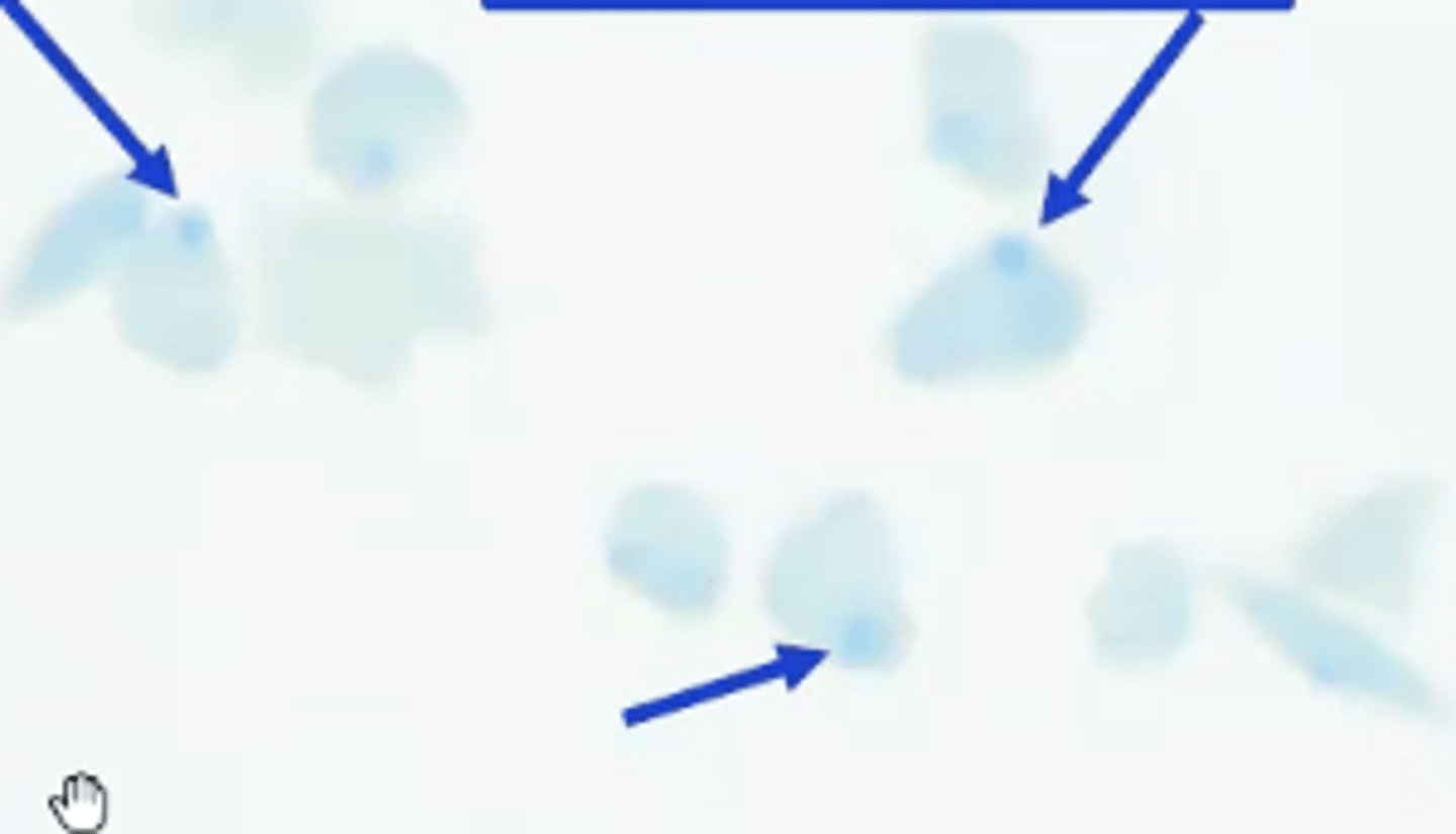 <p>- Hemoglobin is prone to oxidation at -SH groups. Precipitated oxidized hemoglobin pushes RBC membrane outward</p><p>- Heinz bodies can be seen in Wright's stained smears, but are easier to find in vital stained smears</p>