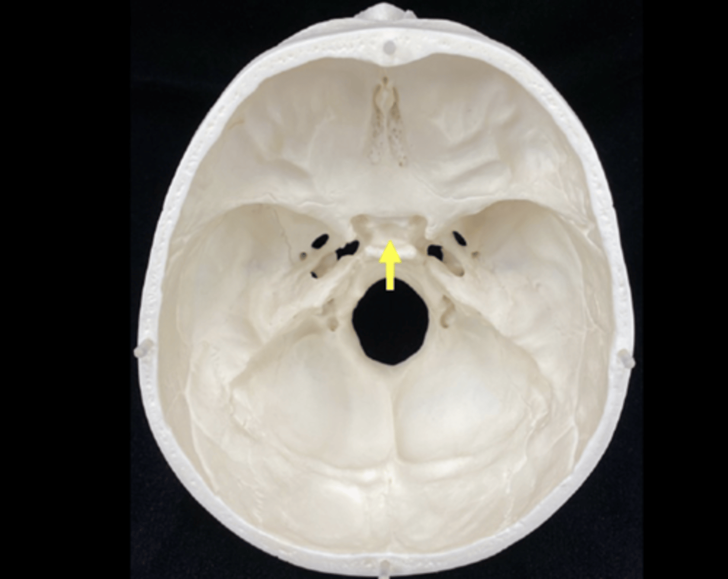 <p>name the bone and bone feature</p>