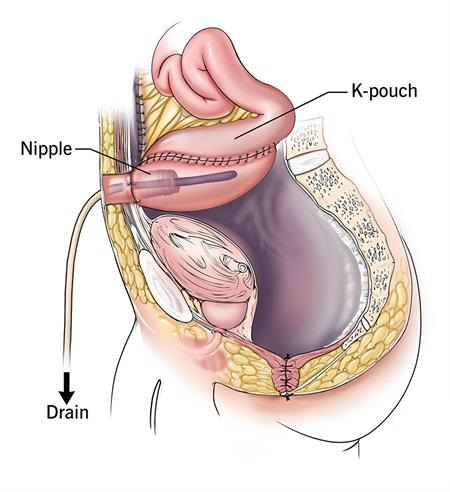 <p>K-Pouch or BCIR</p><p>This surgery turns the small intestine into an internal reservoir (no external appliance needed)</p><p>FYI: poop is stored there and patient can manually get ride of it by turning a valve</p>