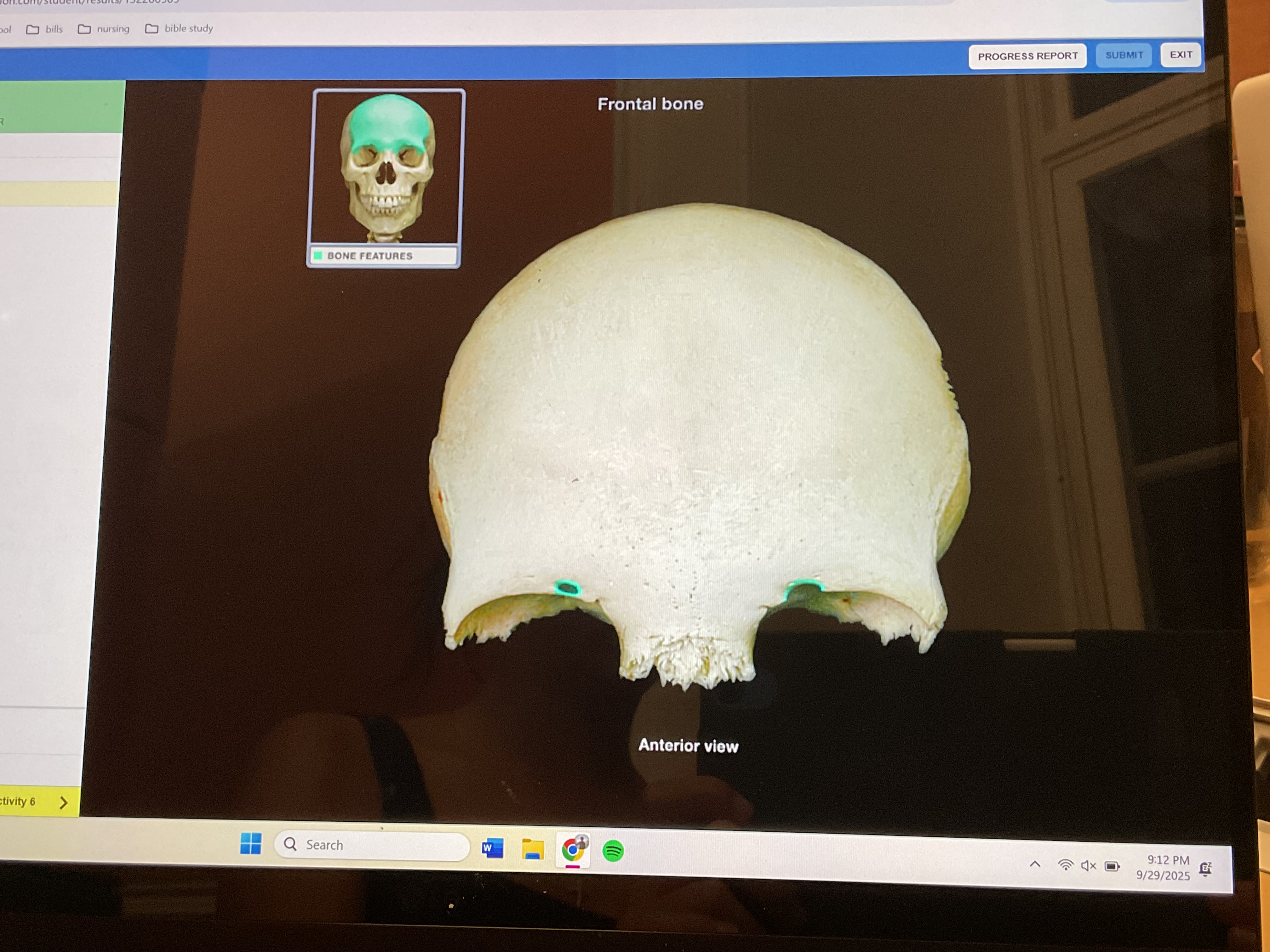 <p>Supraorbital notch </p>