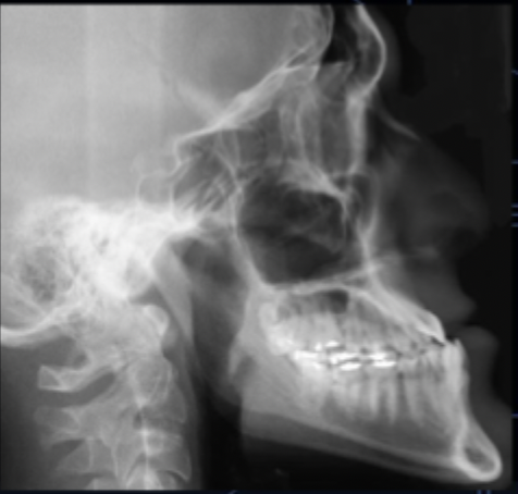 <p>what class of occlusion is shown in this x-ray? </p>