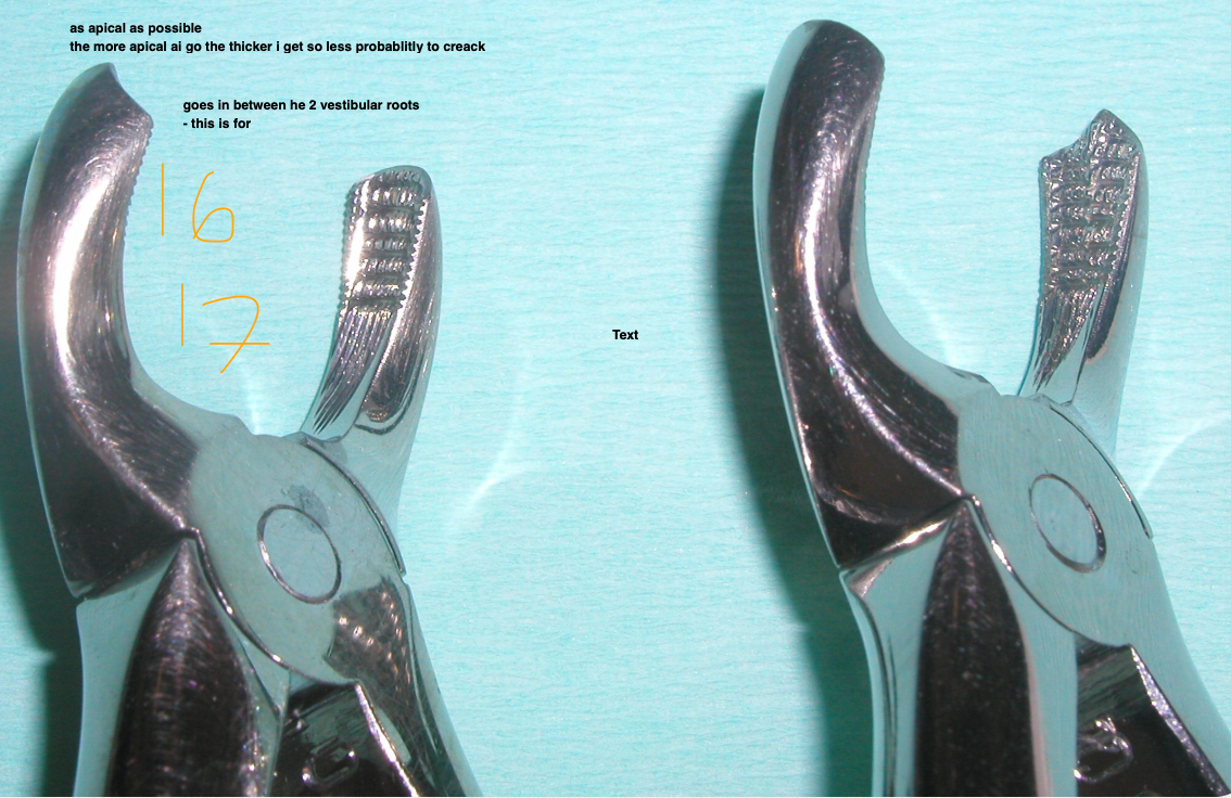 <p><strong>Syndesmotomy</strong> and <strong>luxate</strong> (bc-pt) with straight elevator&nbsp;</p><p><strong>Grip- Palatal side</strong>- grip with a <strong>ribbed, straight valve</strong></p><p><strong>Buccal side</strong>- forceps beak positioned into the <strong>interradicular furcation</strong></p><p>Circumduction- rotate</p><p>Traction&nbsp;</p><p>Odontosection if roots too divergent or fractured&nbsp;</p>