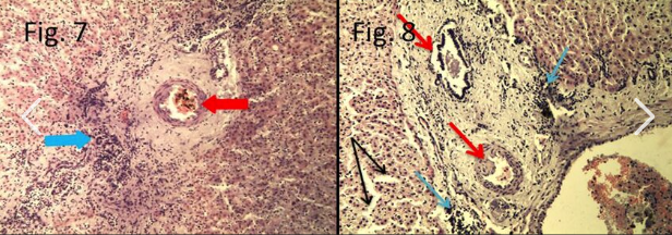 <p>Fasciola may cause this to sheeps, alpaca and llamas. It may become a subclinical infection in cattle.</p>