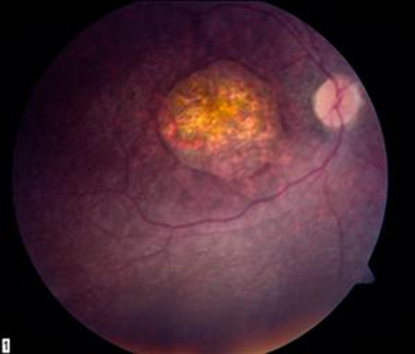 <p>macular atrophic lesion</p><p>attenuated BV</p><p>peripheral pigmentary changes</p>