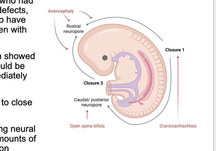 <p><strong>increases</strong> risk of neural tube defects</p><ul><li><p>MRC vitamin study → showed that about 80% of neural tube defects could be prevented by taking <strong>4 mg folic acid</strong> <strong>immediately BEFORE pregnancy</strong></p></li><li><p>defects result when the neural tubes <u>fail to close properly</u></p><ul><li><p>rapidly dividing cells of the developing neural tube requires the synthesis of <u>large amounts of nucleotides</u> to facilitate DNA replication</p></li></ul></li></ul><p></p>