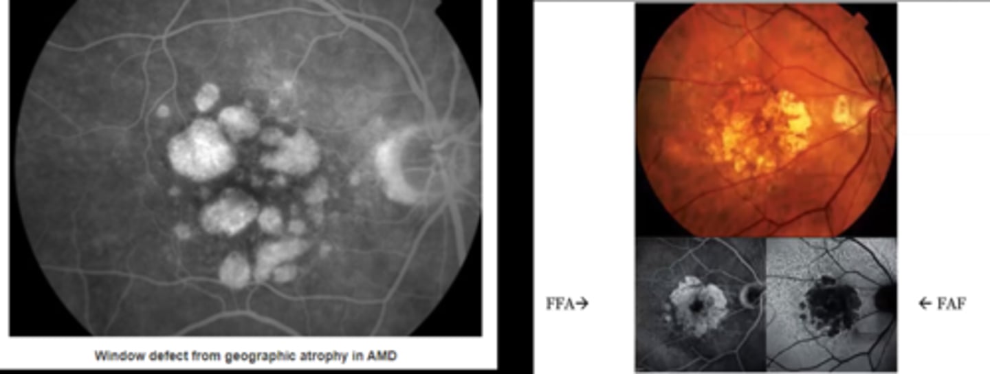<p>RPE loss (i.e. geographic atrophy from AMD)</p><p>retinal hole</p>