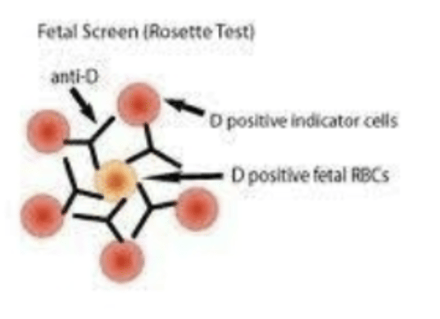 <p>Wash maternal RBCs - make a 2-5% susp</p><p>Add modified anti-D reagent from kit to 1 drop RBCs</p><p>incubate 37C for 15 mins</p><p>Wash 4 times, add R2R2 indicator cells from kit</p><p>If Rh+ fetal RBCs are in maternal circulation, anti-D attaches, then R2R2 indicator cells attach in a rosette formation</p><p>Count the rosettes/field x 5 fields</p><p>Usually 3 or 5 rosettes = POS Rosette Test</p>
