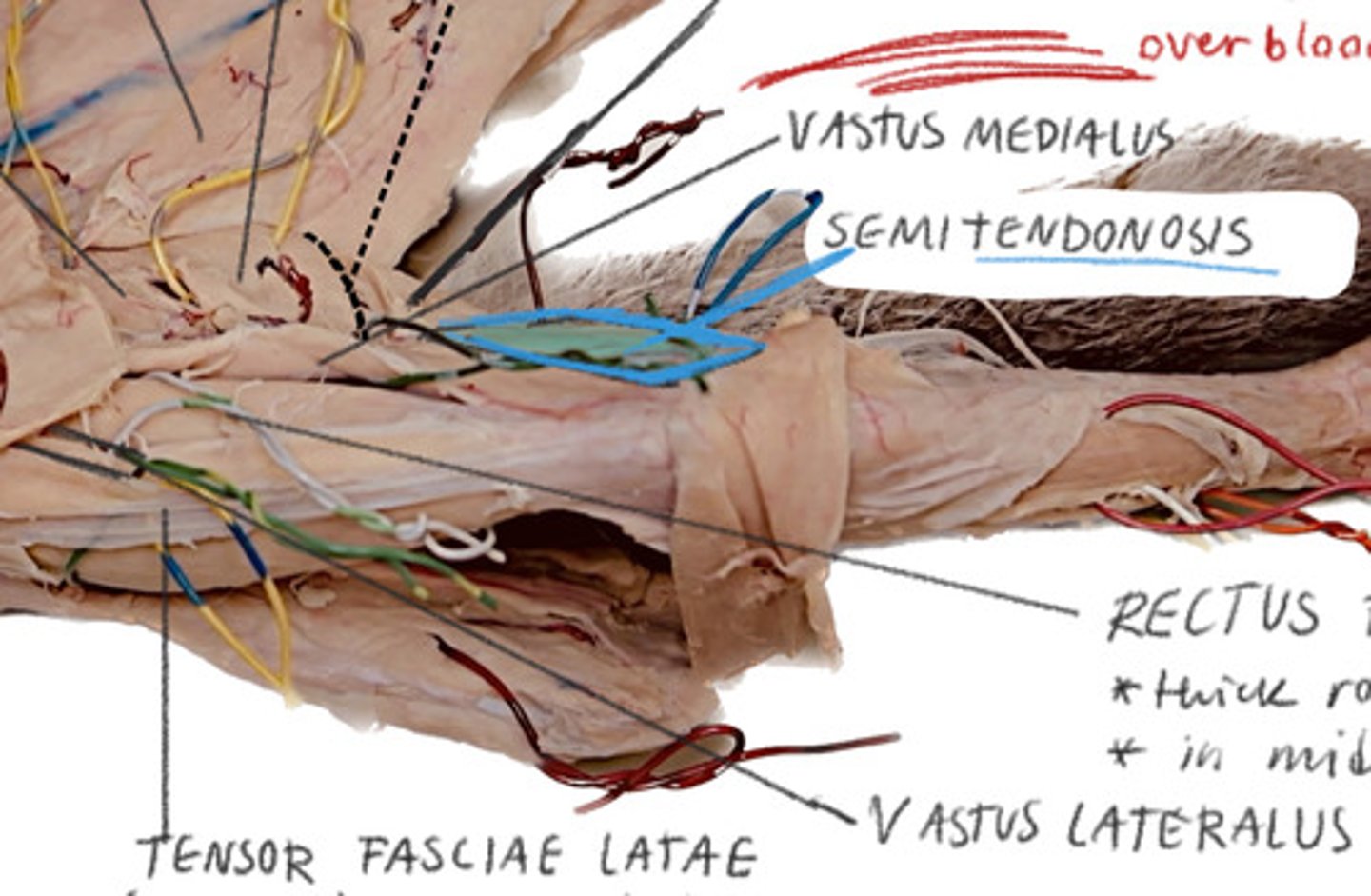 <p>Beneath the gracilis flap on the medial side of thigh</p>