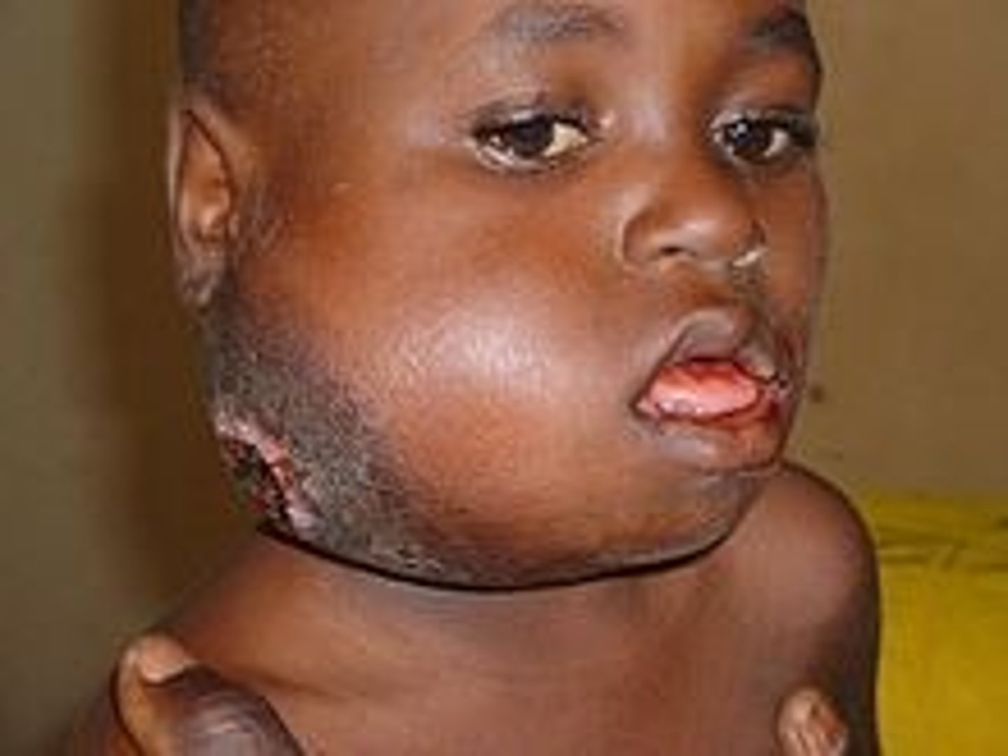 <p>jaw tumor that is strongly linked to the Epstein-Barr virus</p>