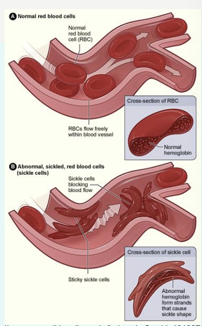 <p>heterozygotes in certain genes makes them superior to either homozygote (2 identical alleles) - e.g. sickle cell anaemia where heterozygotes have resistance to malaria</p><p></p><p>inherit the mutation for a gene encoding haemoglobin</p><ul><li><p>mutation leads to a haemoglobin that forms chains instead of globular shape</p></li><li><p>this distorts the cells making them “sickle” shaped and fragile</p></li><li><p>the sickle cells can occlude vessels and break impairing O2 carrying capacity</p></li><li><p>HbA - normal, HbS- sickle</p></li></ul><p></p><p>sickle cell anaemia is autosomal recessive</p><p>affected homozygotes often have a decreased life expectancy</p><p></p><p>» Heterozygotes are affected but to a lesser degree – “sickle cell trait”.</p><p>• Have enough production of HbA to offset HbS.</p>