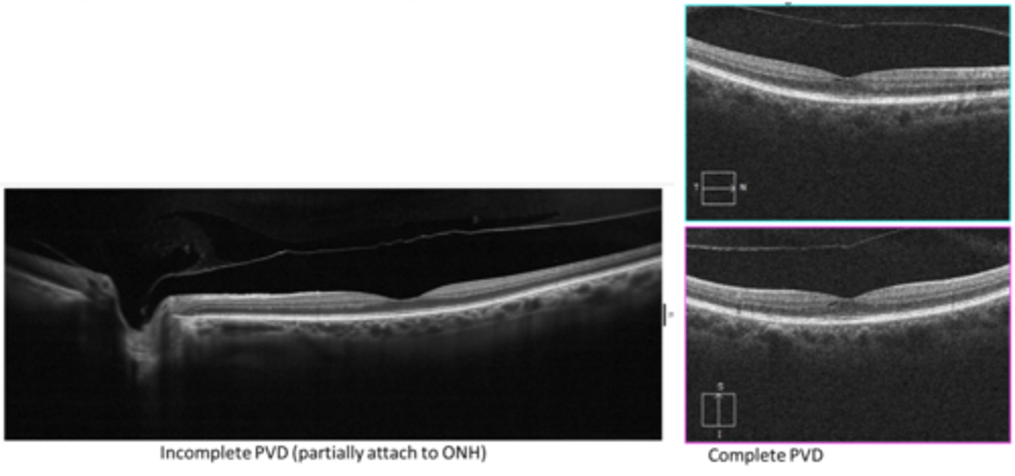 <p>posterior hyaloid partially or fully detached and floating above retina (may be too anterior to see if longstanding)</p>