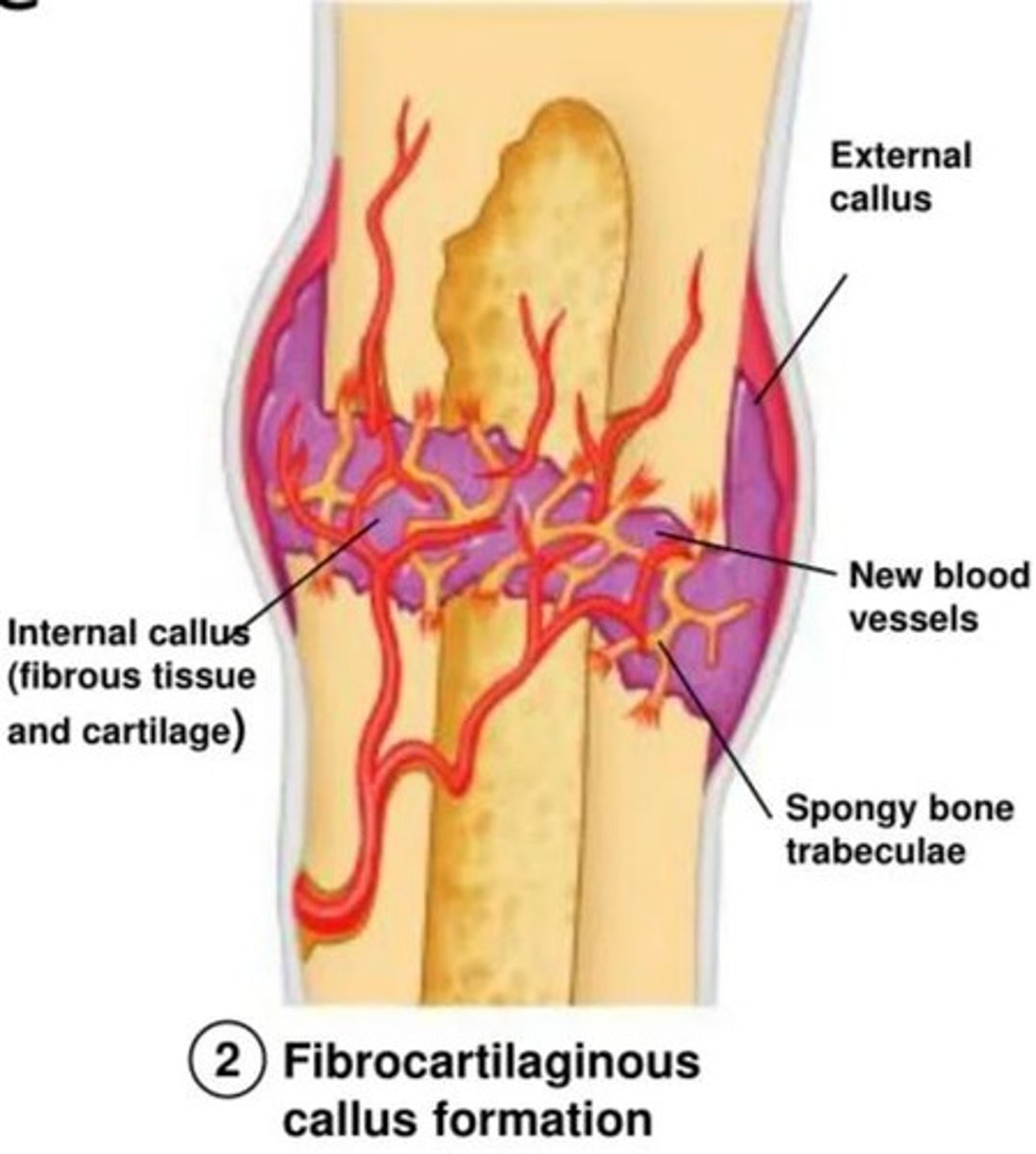 <p>fibrocartilage callus is gradually replaced with a spongy bone callus. osteoclasts and osteoblasts appear</p>
