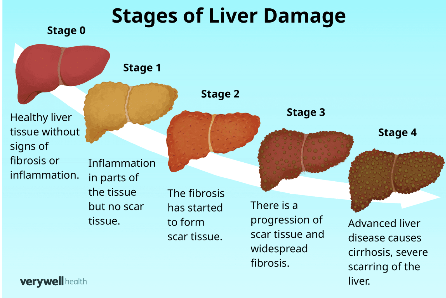 <p>What are the stages of liver function</p><ul><li><p>inflammation&nbsp;</p></li><li><p>fibrosis&nbsp;</p></li><li><p>cirrhosis&nbsp;</p></li><li><p>end-stage liver failure&nbsp;</p></li></ul><p></p>