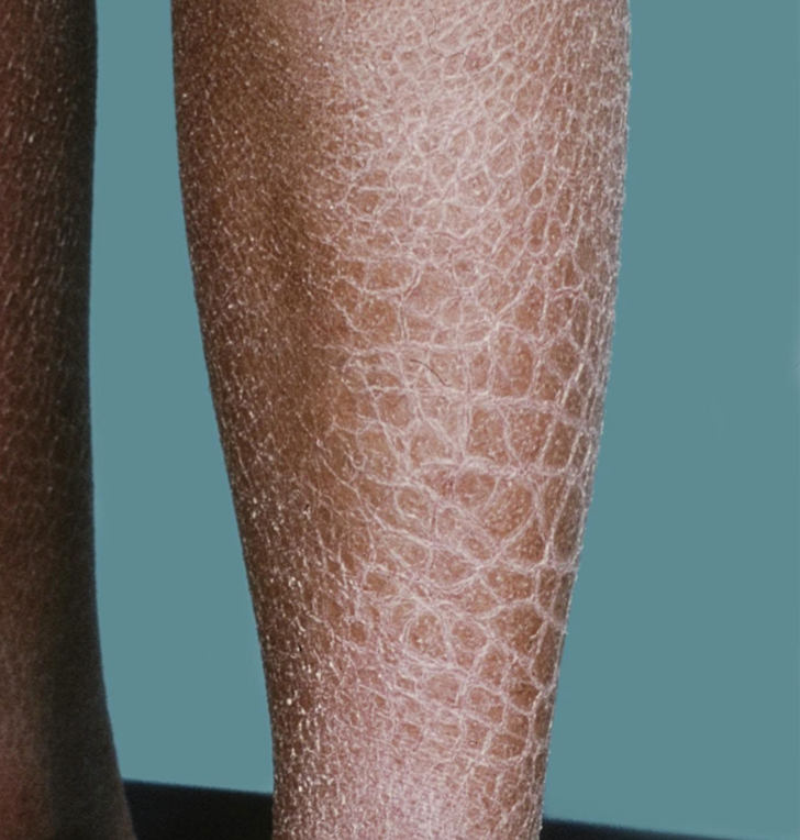 <p>what type of lesion and what condition is depicted</p>