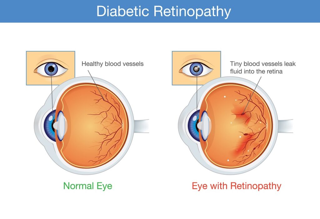 <ul><li><p>Chronic elevated levels of glucose can damage the small blood vessels in the retina, leading to leakage of fluid and blood, causing swelling and bleeding. </p></li><li><p>This can result in <strong>diabetic retinopathy</strong>, where the damaged vessels may also lead to the formation of abnormal new blood vessels, further impairing vision and potentially causing blindness.</p></li></ul><p></p>