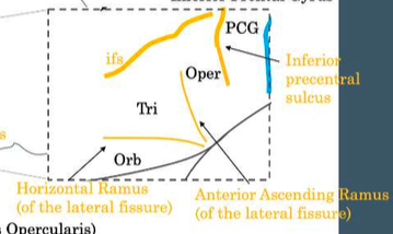 <p>separates pars triangularis and pars orbitalis</p>