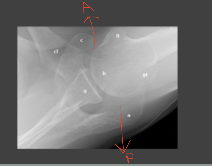 <p>Normal axillary view for reference</p>