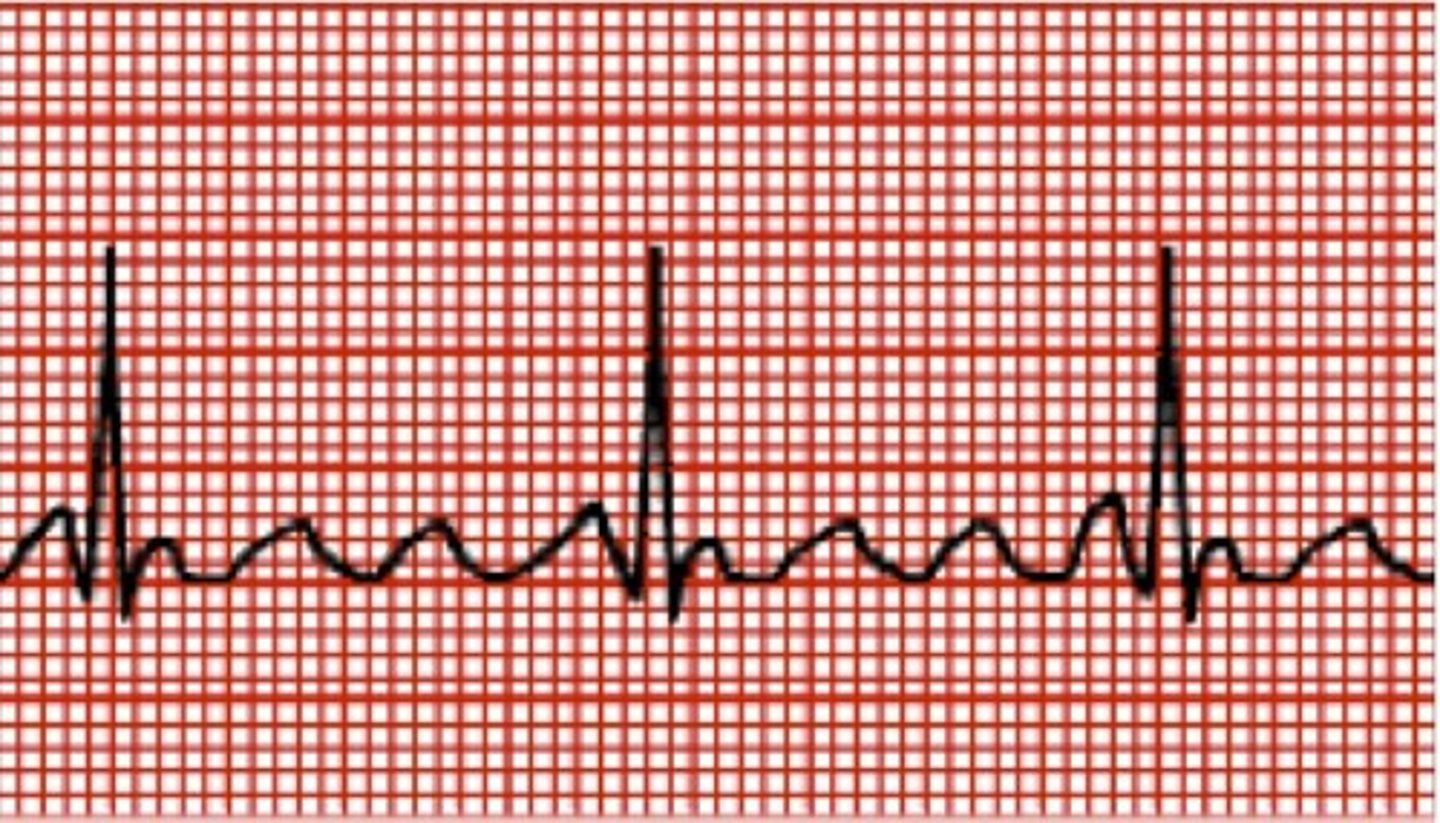 <p>- saw-tooth P-wave with a single ectopic focus in the atria and heart rate of 200-350 BPM</p><p>- "Flutters" shown indicate how many times the electrical current runs around the atrium before going to the ventricle</p><p>- Treatment: antidysrhythmic, cardioversion, radiofrequency ablation (high rates of energy focused at ectopic focus)</p>