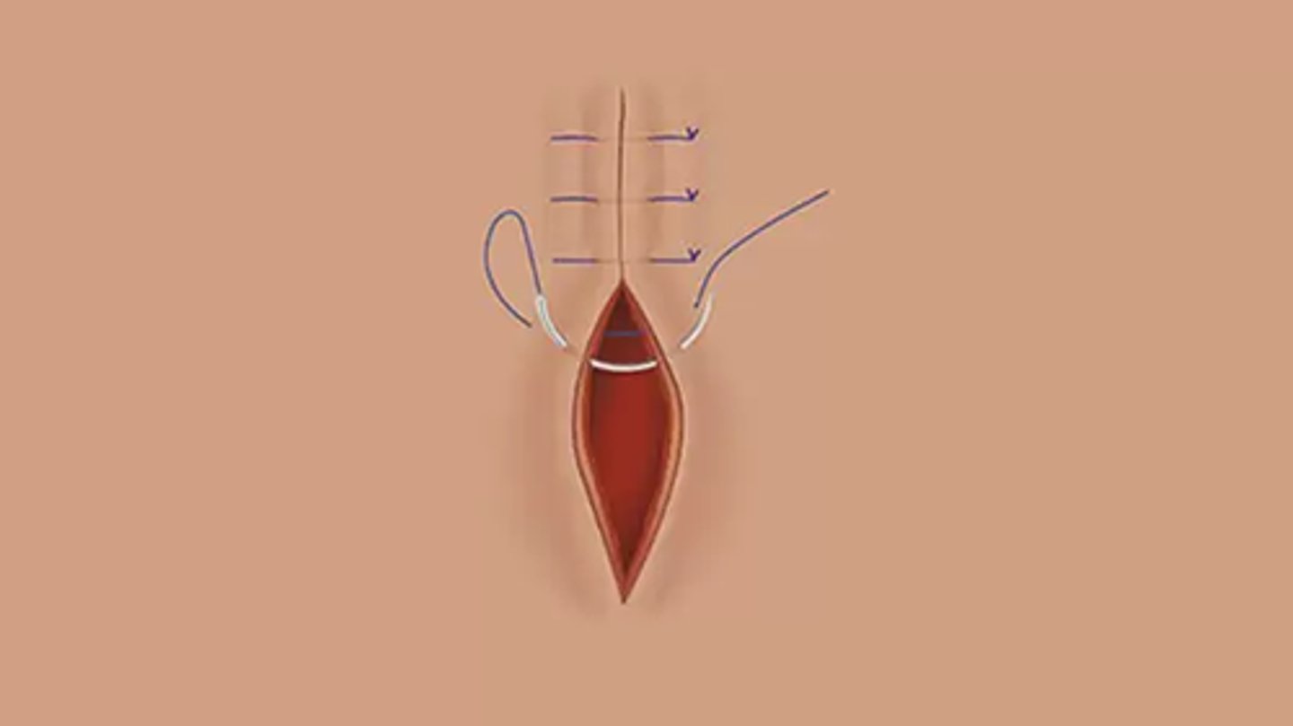 <p>Used when suturing a flap<span> or closer DEEPER wounds (scalp), in which closure occurs at two levels (superficial and deep), eliminating dead space</span></p><p>*far/far/near/near</p>