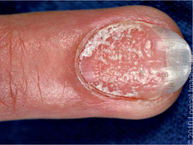 <p>dystrophy of nail plate; areas of small depression or “pits”</p><p>ex: autoimmune, psoriasis, FHx</p>