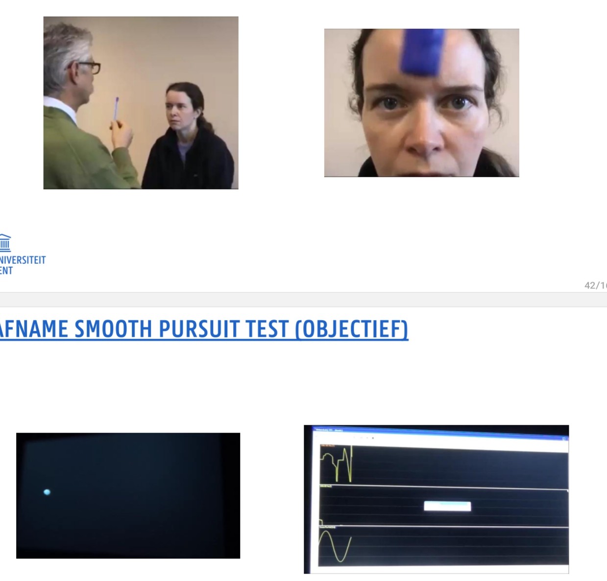 <p>DOEL: blik stabilisatie tijdens kijken naar bewegende objecten binnen het visuele veld<br>AFNAME: Patiënt volgt een object (vinger of lichtpuntje) dat langzaam heen en weer beweegt, ZONDER hoofd te bewegen</p><ul><li><p>Snelheid en amplitude kunnen aangepast worden</p></li><li><p>Saturatie voor target snelheden > 50°/s => saccades</p></li><li><p>Oculair patroon is een trage, gladde oogvolgbeweging</p></li></ul><p>naar boven (boven as maar met oenemende en afnemende snelheid)= R, naar onder (dus onder as) = L</p>