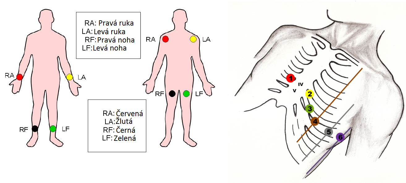 <p>12svodový záznam:</p><ul><li><p>3 končetinové bipolární (I, II, III)</p></li><li><p>3 končetinové unipolární zesílené (aVR, aVL, aVF)</p></li><li><p>6 unipolárních hrudních (V1-V6)</p></li></ul><p></p>