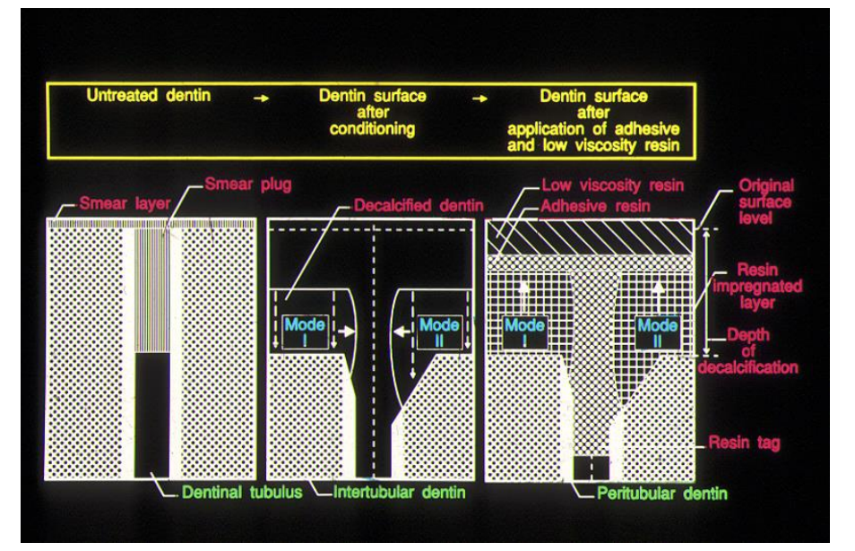 <p>composite restoration is usually hydrophobic - layered interface to achieve a satisfactory bond to the tooth </p>
