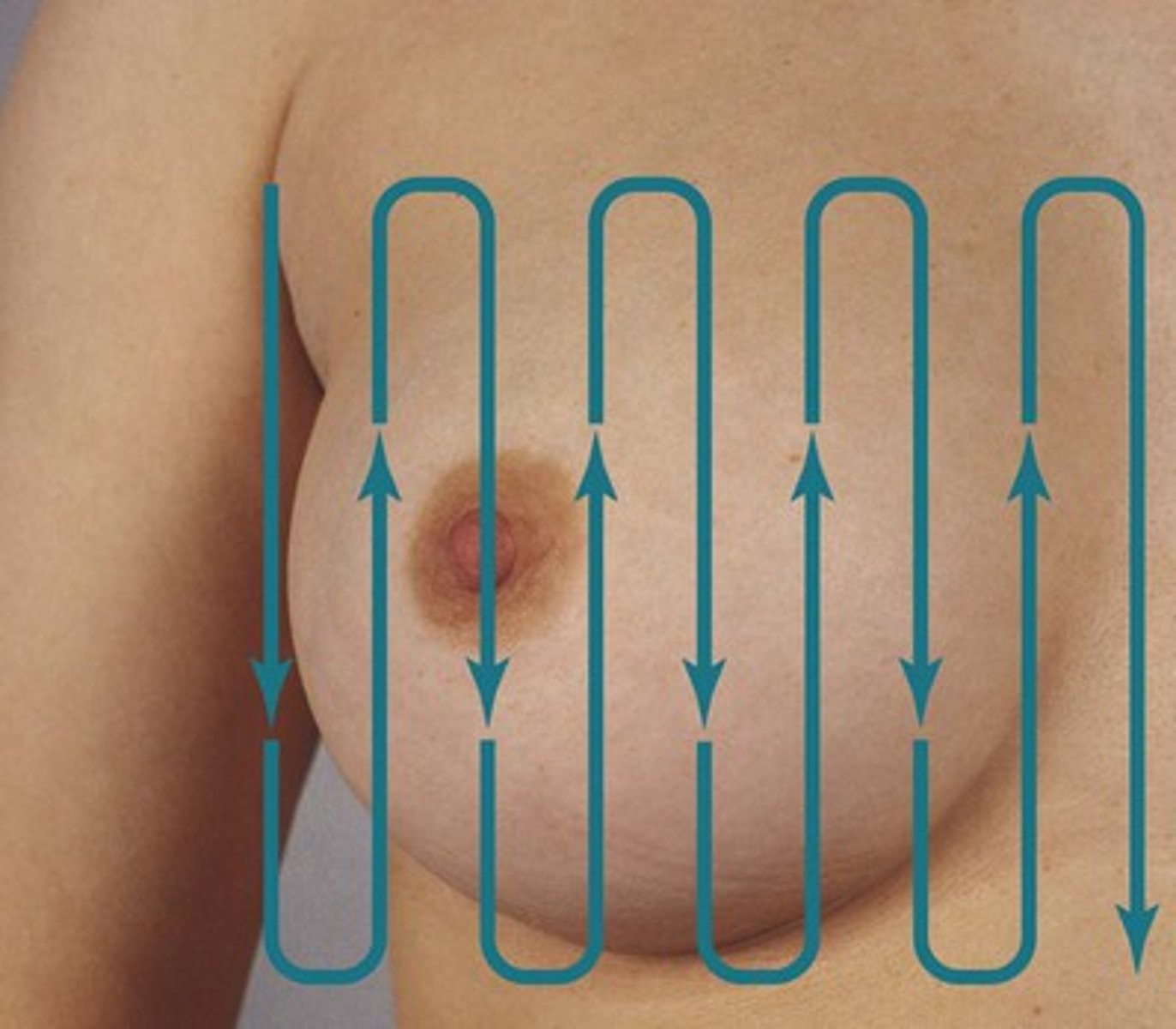 <p>is the best way to detect a breast mass, but two other patterns are in common use: from the nipple palpating out to the periphery as if following spokes on a wheel and palpating in concentric circles out to the periphery.</p>