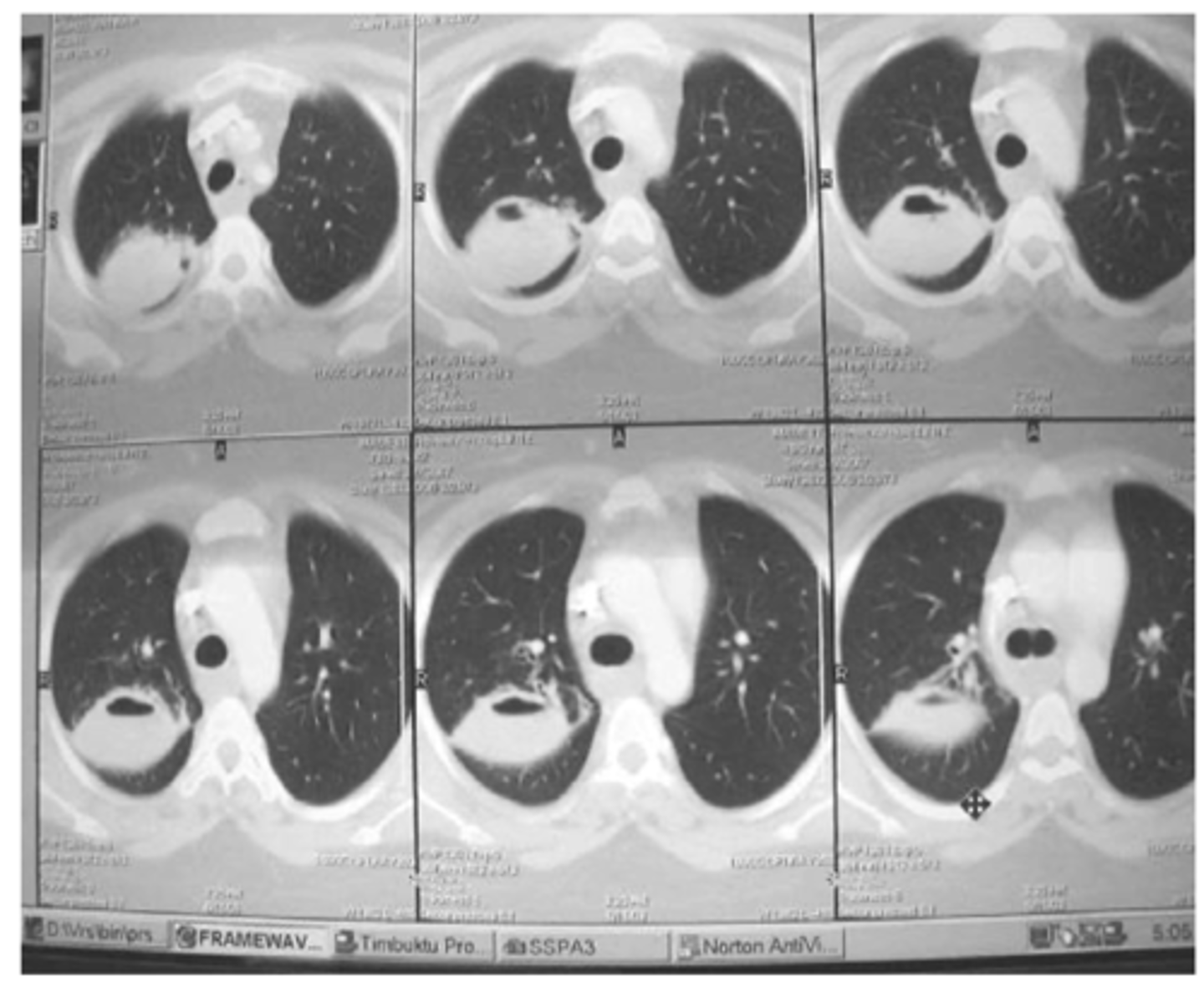 <p>What is best study for empyema?</p>