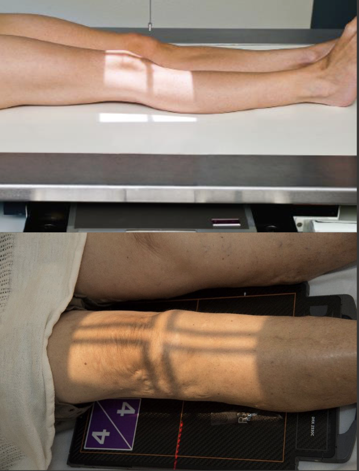 <p>Fine FS, 100cm</p><p>65kVp, 5mAs</p><p>Straight tube</p><p>CR: 2cm inferior to patellar apex</p>