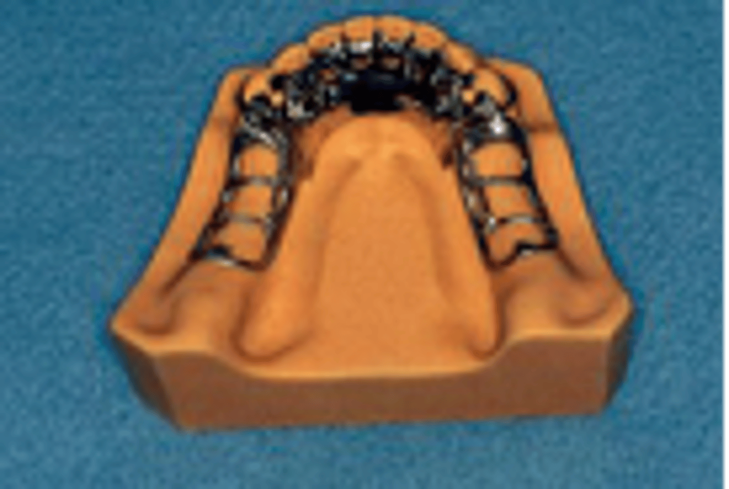 <p>Major connector used when: </p><p>§ High lingual frenum or &lt;8mm +/-</p><p>§ Excessive residual ridge resorption</p><p>§ Future anterior tooth replacement (perio, caries)</p><p>§ Lingual tori that would be impinged upon by a lingual bar</p>