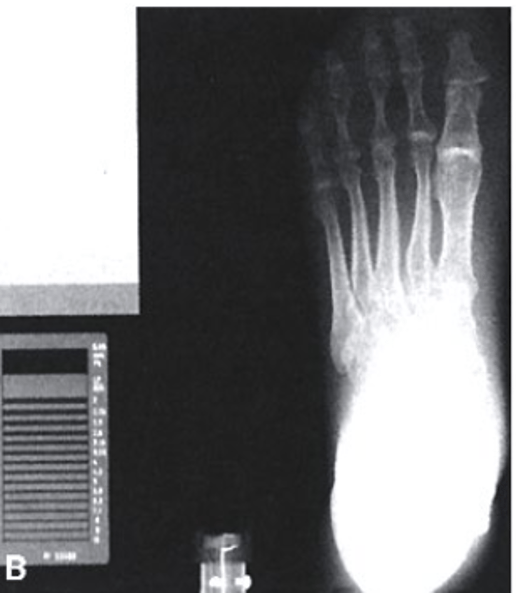 <p>Which of the following would be used to describe this radiograph?</p><p>a. Underexposed</p><p>b. Correctly Exposed</p><p>c. Overexposed</p>