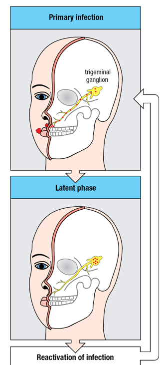 <p>Initial infection around the lips is cleared by the immune response and while healing is manifested as cold sores (upper panel). Meanwhile, the virus (small red dots) enters sensory neurons, such as the trigeminal ganglion that innervates the lips, where it persists in a latent state (lower panel). At a later time, stress can cause the virus to leave the neurons and reinfect epithelial cells. This reactivates the immune response and causes cold sores. During this active phase, the virus can pass from one person to another.</p>