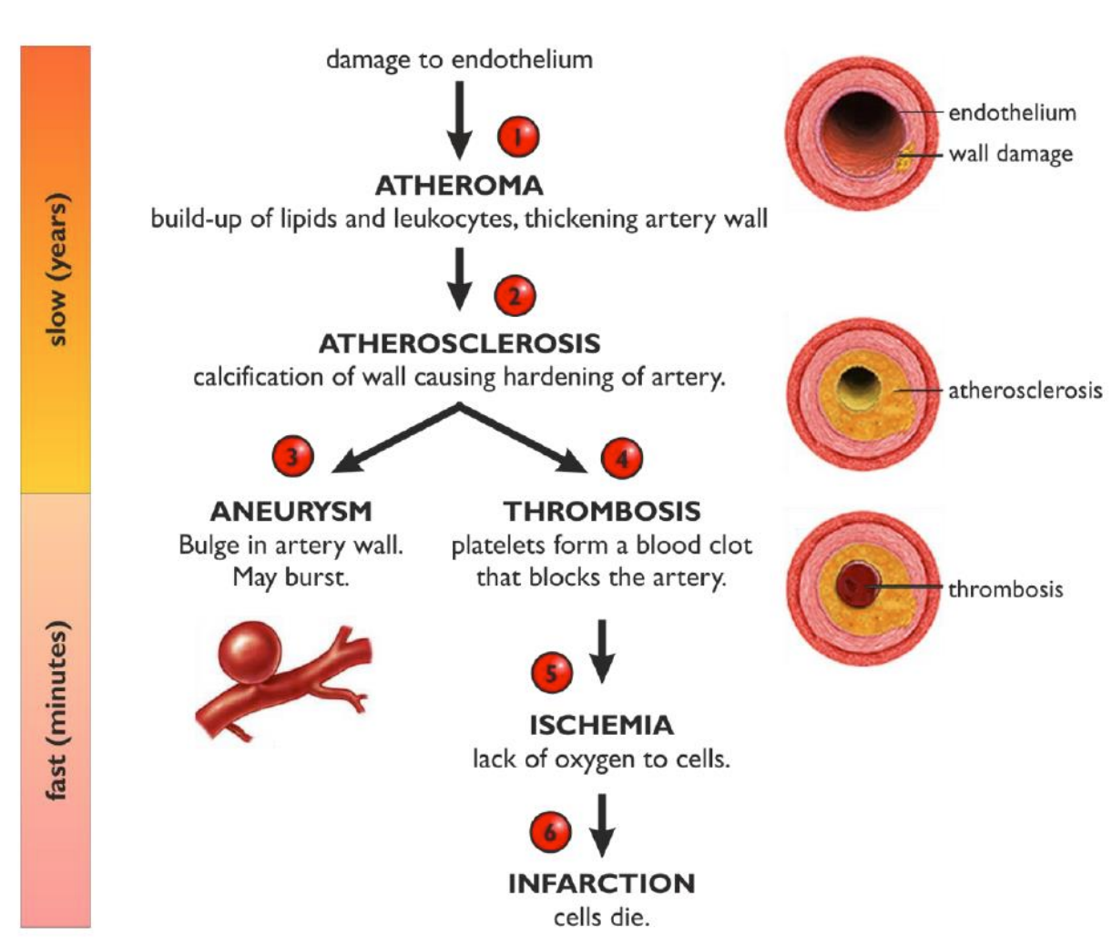 <p>Build-up of fibrous plaque (atheroma):</p><ul><li><p>endothelium becomes damaged which can cause a blood clot</p></li><li><p>cells, salts, cholesterol &amp; other substances build up &amp; harden, forming a plaque that narrows the artery</p></li></ul><p></p>